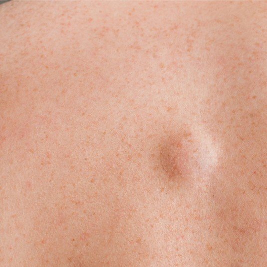 Eliminación de lipoma- Dra. Daniela Correa- Cirujana plástica