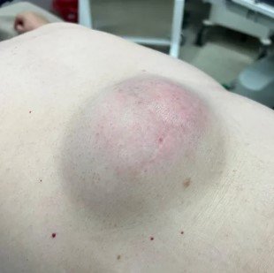 Eliminación de lipoma- Dra. Daniela Correa- Cirujana plástica