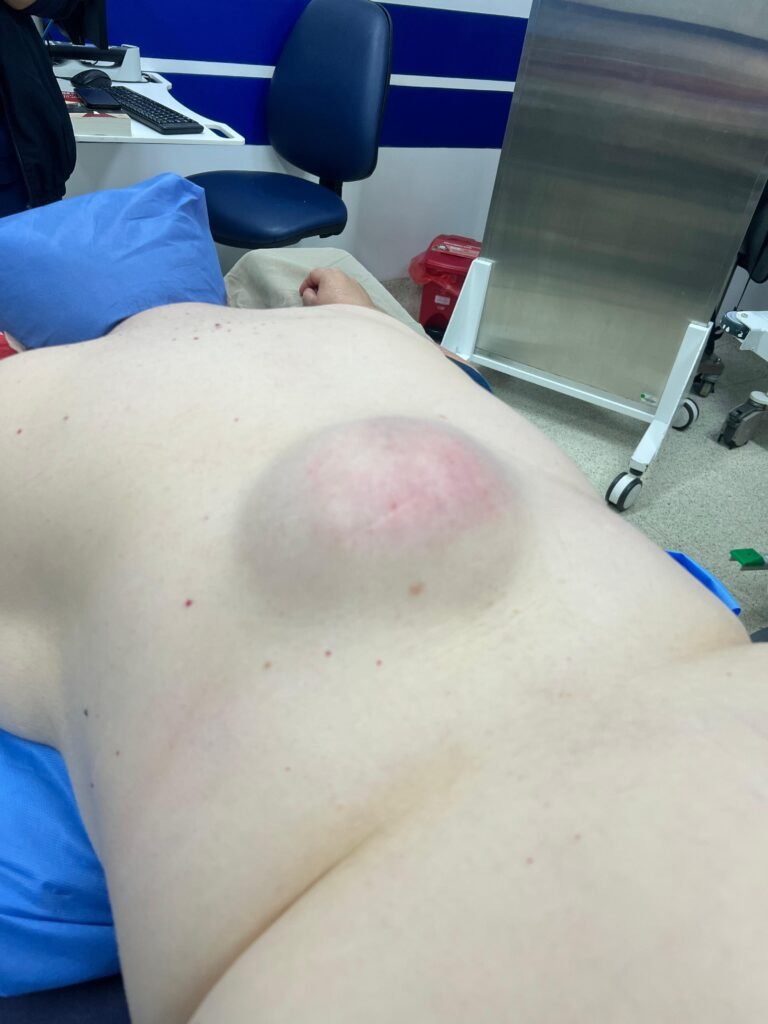 Eliminación de lipoma- Dra. Daniela Correa- Cirujana plástica