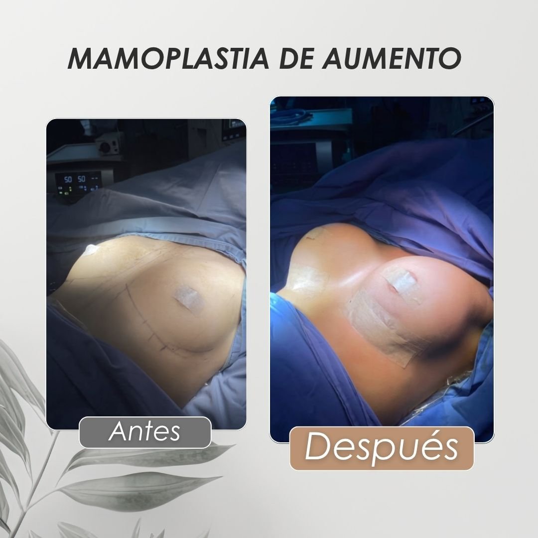 Mamoplastia de aumento Antes y después - Daniela Correa Cirujana