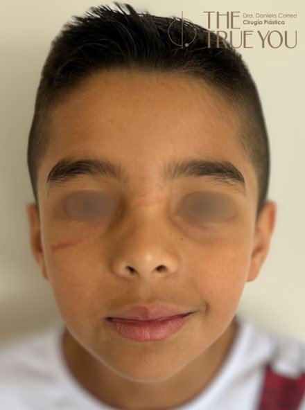 Reconstrucción facial antes y después - después - Dra. Daniela Correa Cirujana