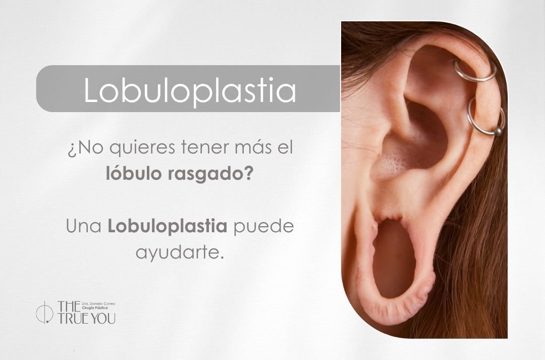 Lobuloplastia en Medellín por la Dra. Daniela Correa Cirujana plástica