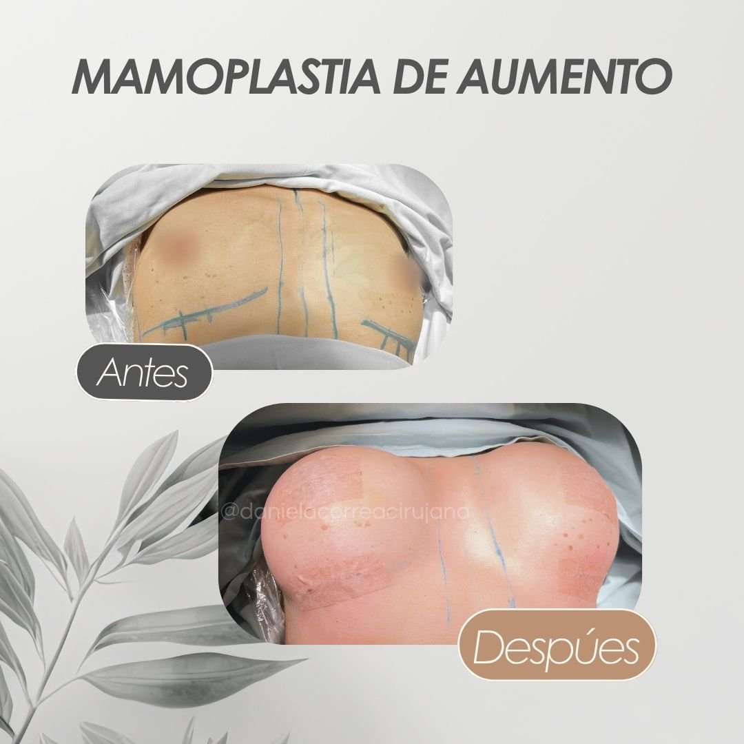 Mamoplastia de aumento Antes y después - Daniela Correa Cirujana
