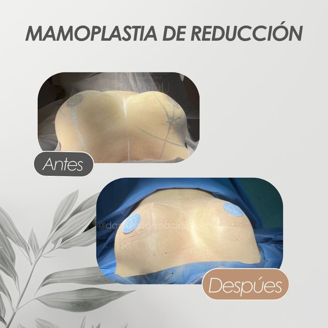 Mamoplastia de reducción antes y después