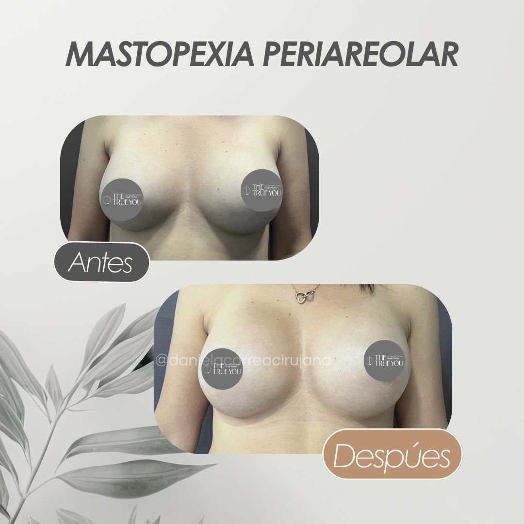 Mastopexia con Implantes Antes y después Dra. Daniela Correa