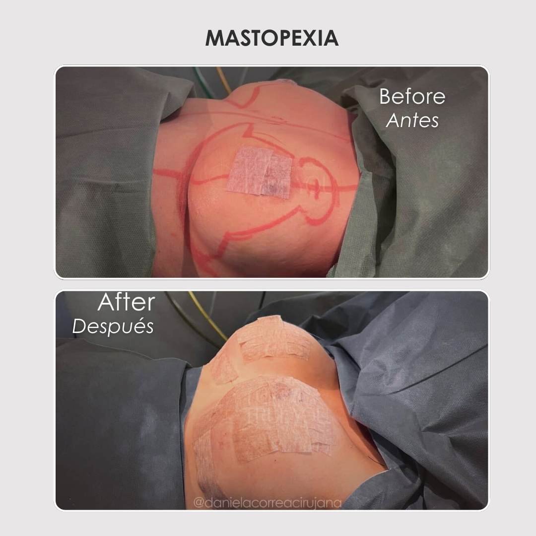 Mastopexia con implantes antes y después - Dra. Daniela Correa (1)