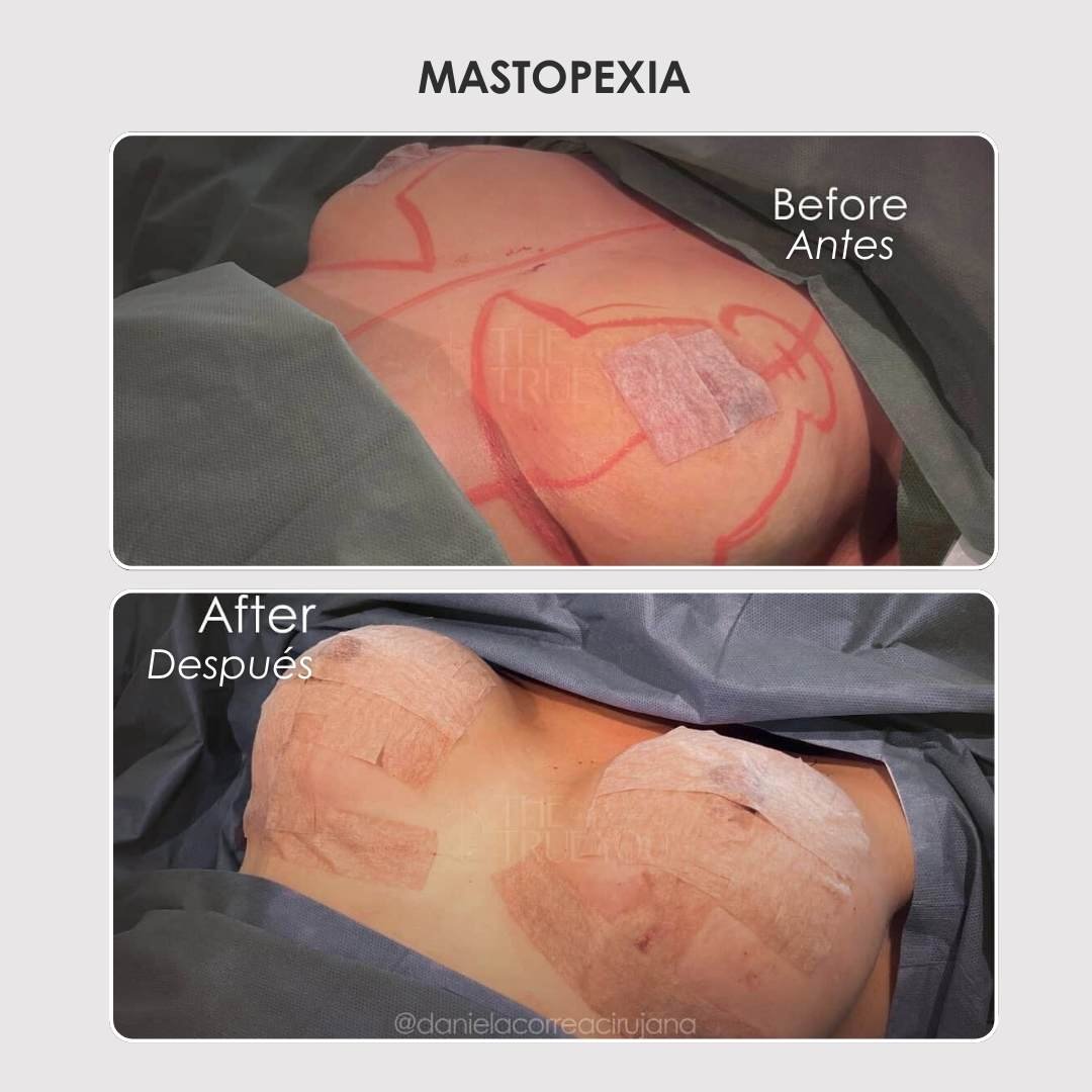 Mastopexia con implantes antes y después - Dra. Daniela Correa - Cirujana plástica en Colombia (2)