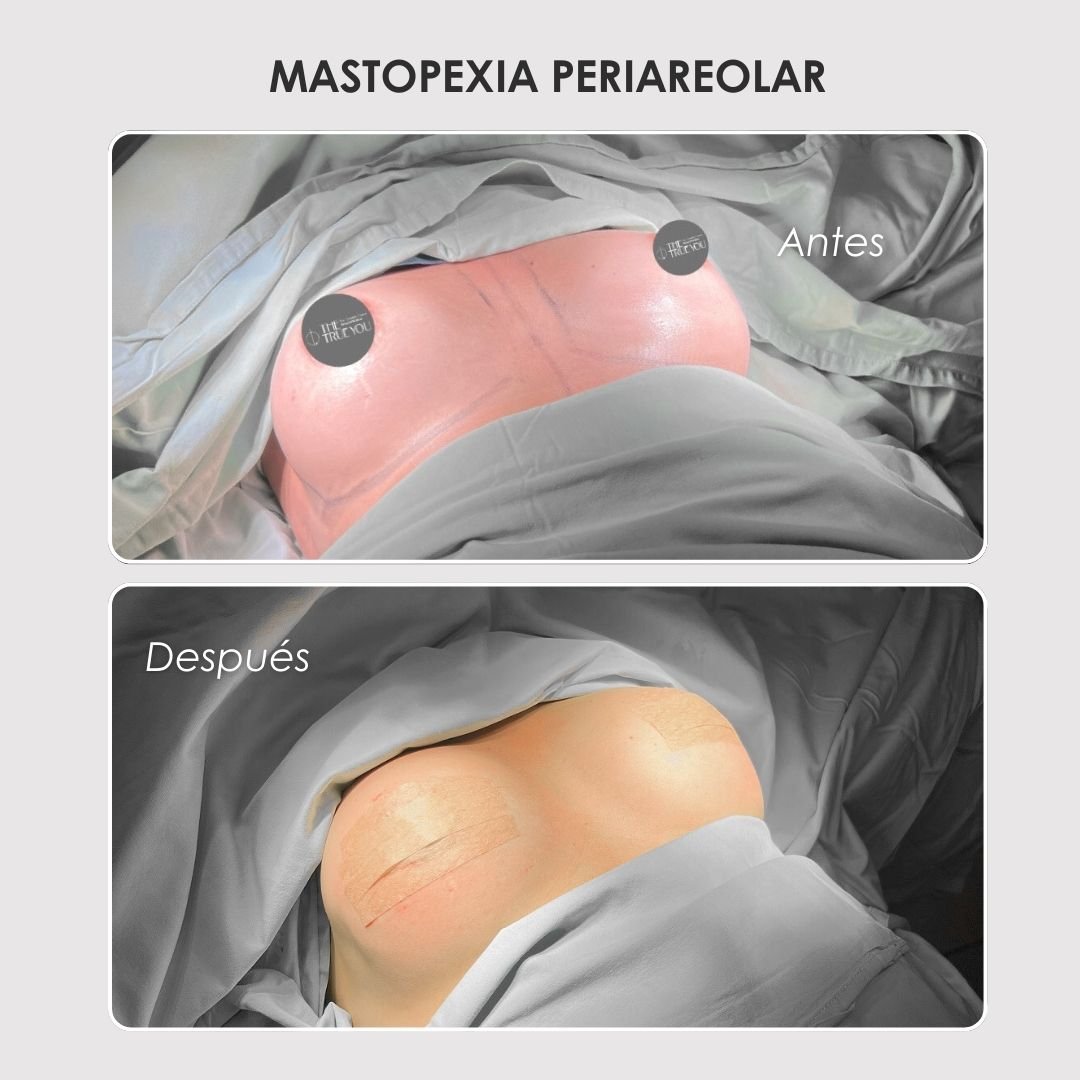 Mastopexia periareolar antes y después - Dra. Daniela Correa cirujana plástica en Colombia 1