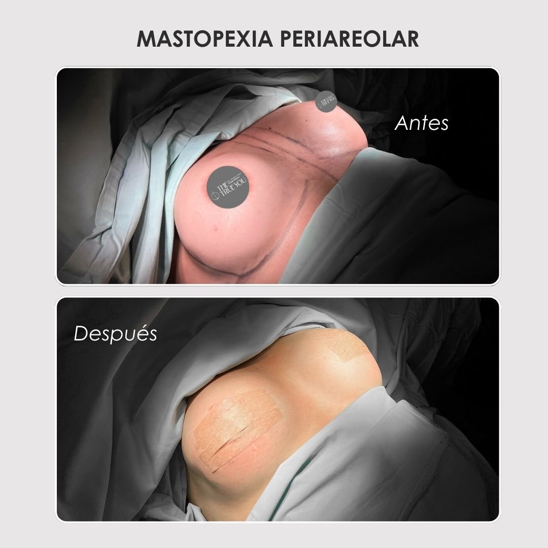 Mastopexia periareolar antes y después - Dra. Daniela Correa cirujana plástica en Colombia