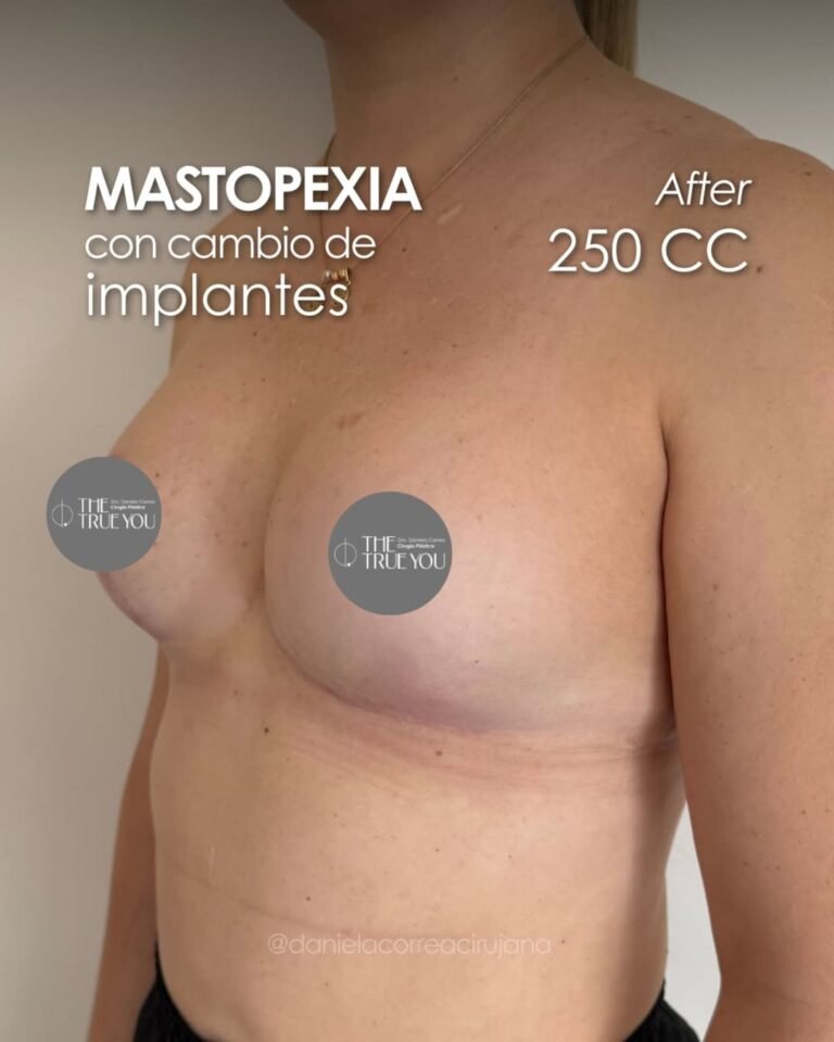 Cambio de implantes-Dra. Daniela Correa