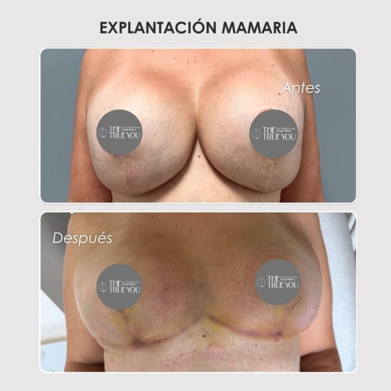 Explantación mamaria antes y después con la Dra. Daniela Correa - 011025 2
