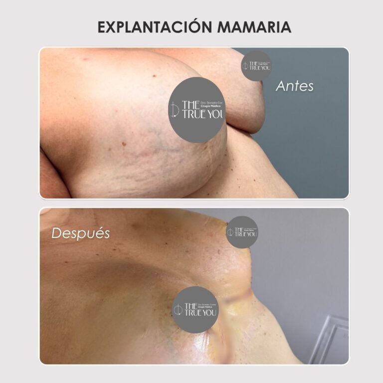 Explantación mamaria antes y después con la Dra. Daniela Correa - 011025