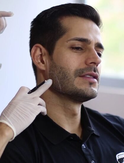 Marcación mandibular hombres - Cirujana plástica de Medellín Daniela Correa
