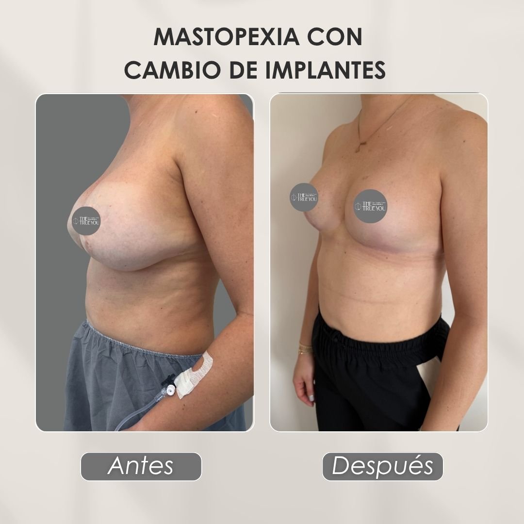 Mastopexia con cambio de implantes antes y después con la Dra. Daniela Correa - 011025