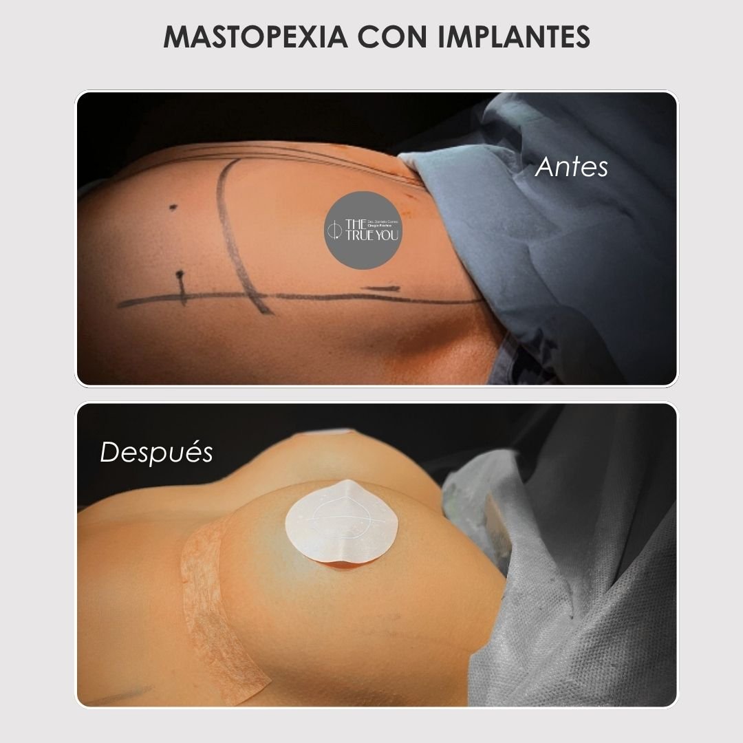 Mastopexia con implantes antes y después con la Dra. Daniela Correa - 011025 2