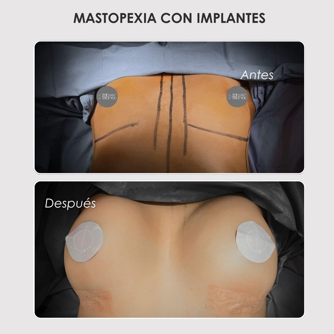 Mastopexia con implantes antes y después con la Dra. Daniela Correa - 011025