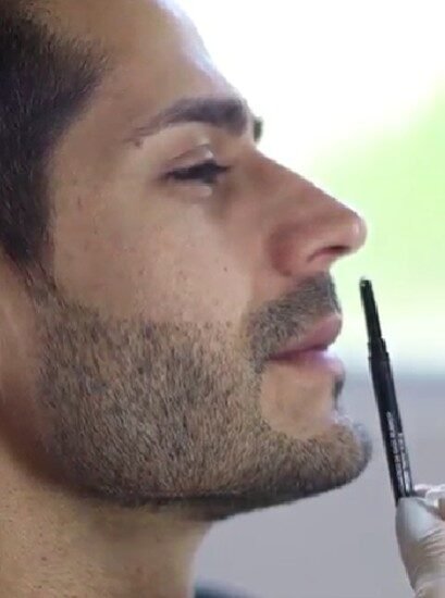 Proyección de mentón con ácido hialurónico - Cirujana plástica de Medellín Daniela Correa