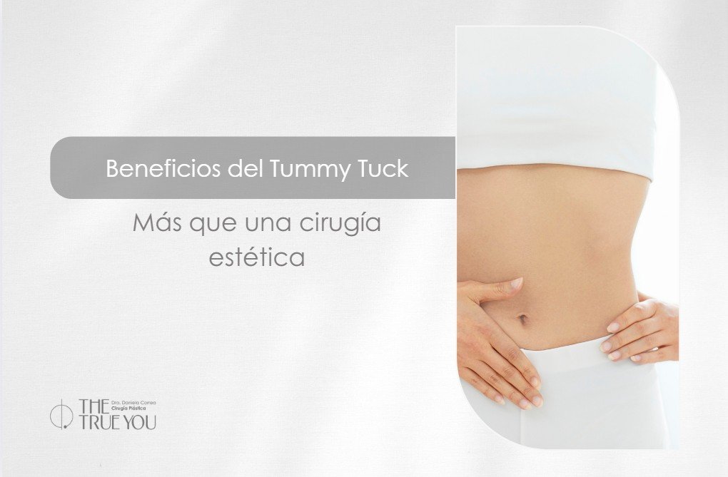 Beneficios del Tummy Tuck-Dra. Daniela Correa