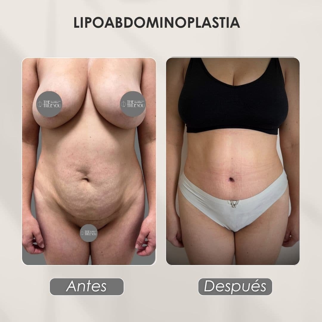 Lipoabdominoplastia antes y después con la Dra. Daniela Correa de Medellín - 041125