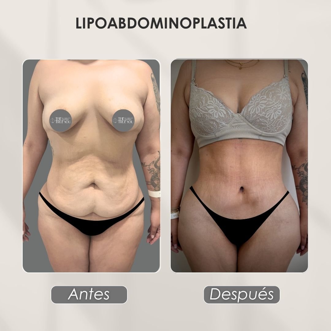 Lipoabdominoplastia antes y después con la Dra. Daniela Correa de Medellín - 041125 2