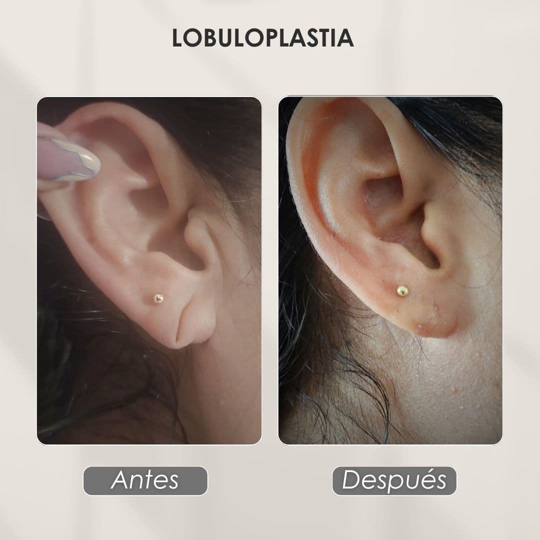 Lobuloplastia antes y después con la Dra. Daniela Correa de Medellín - 041125
