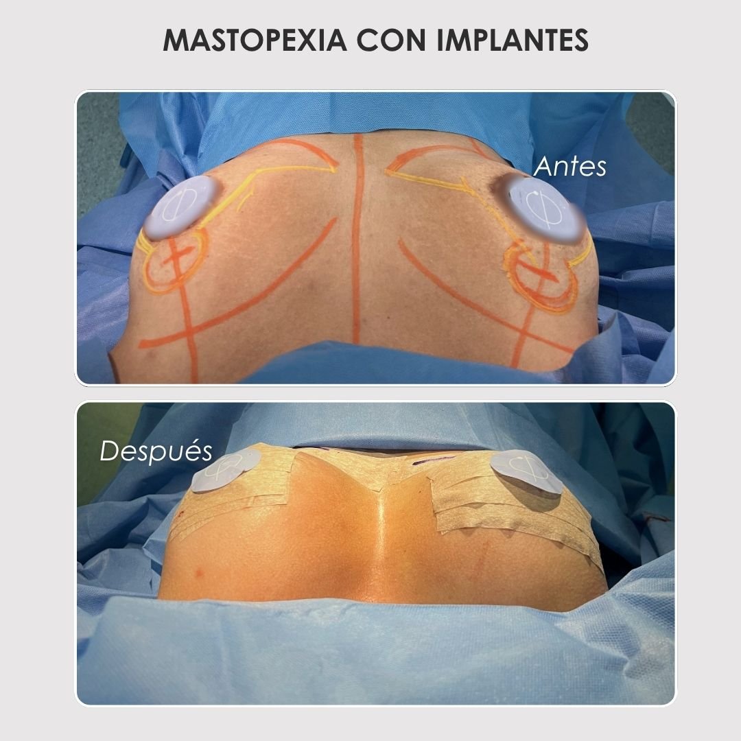 Mastopexia con implantes antes y después con la Dra. Daniela Correa de Medellín - 041125