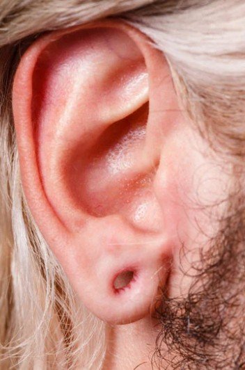 Top 5 de cirugías plásticas en Medellín en 2025 - Lobuloplastia - Daniela Correa cirujana