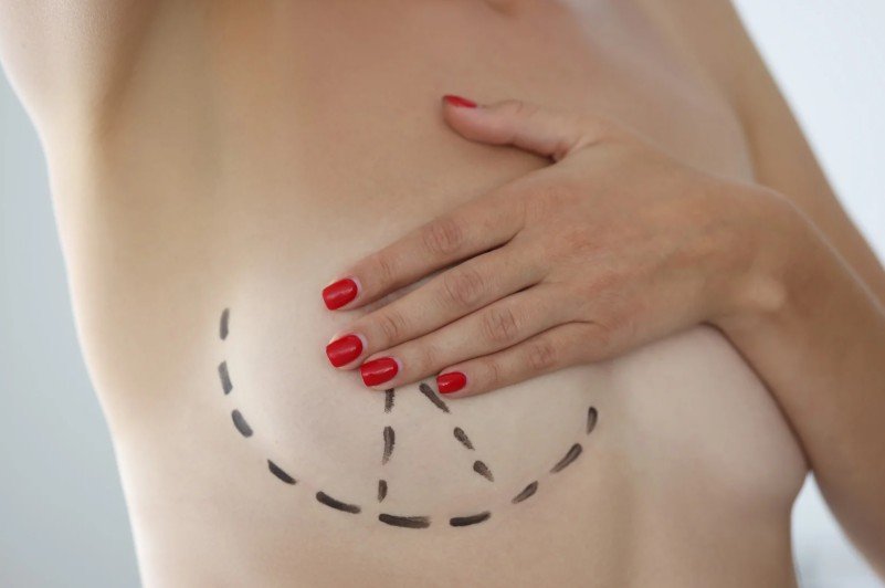 Top 5 de cirugías plásticas en Medellín en 2025 - Mastopexia - Daniela Correa cirujana