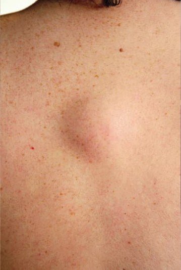 Top 5 de cirugías plásticas en Medellín en 2025 - Resección de lipoma - Daniela Correa cirujana