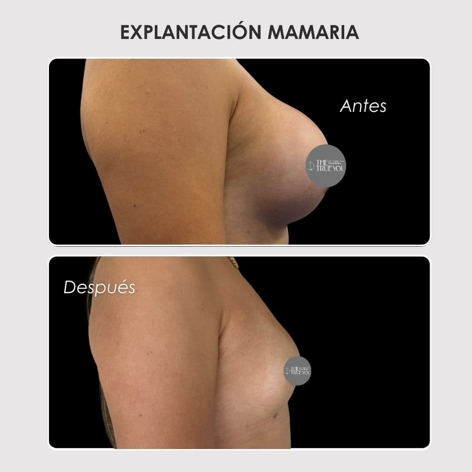 Explantación mamaria - caso de antes y después - Dra. Daniela Correa