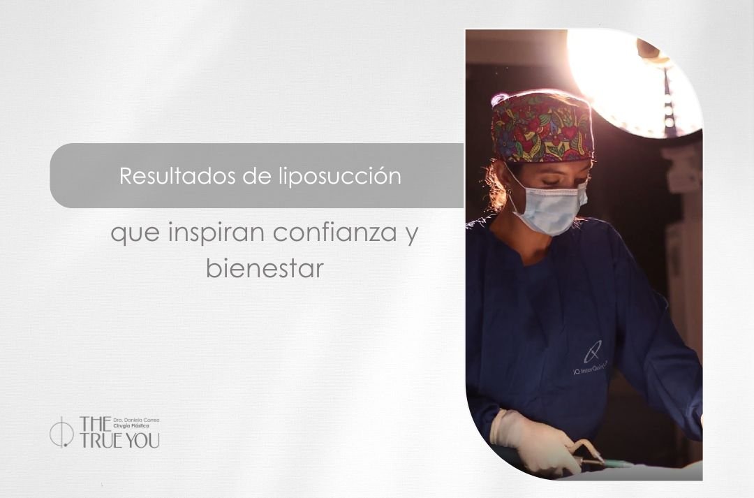 Liposucción resultados - Cirujana plástica de Medellín Daniela Correa