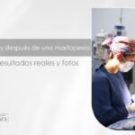 Mastopexia antes y después - Cirujana plástica en Medellín Daniela Correa