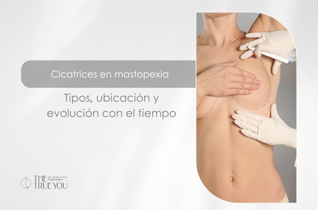 Mastopexia cicatriz - Cirujana plástica en Medellín Daniela Correa