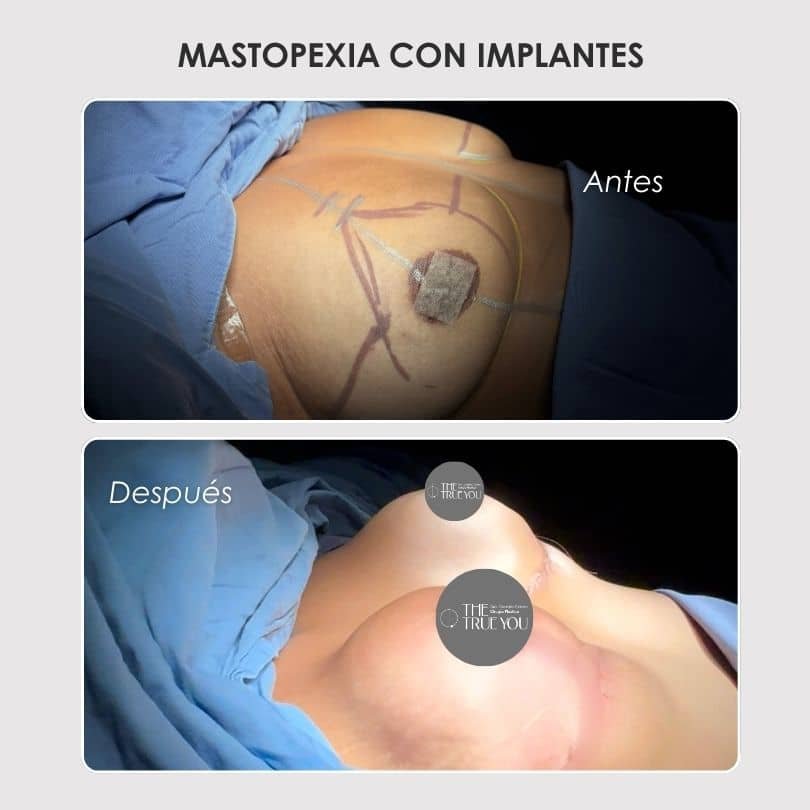 Mastopexia con implantes - Dra. Daniela Correa - Caso de antes y después