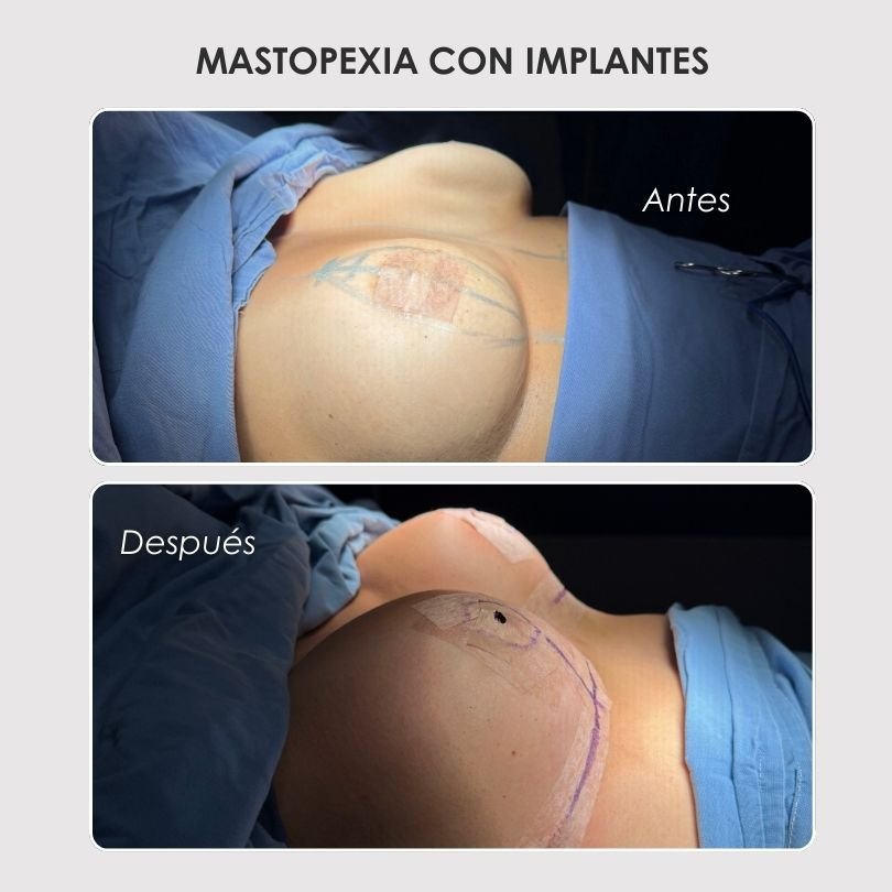 Mastopexia con implantes - caso de antes y después - Dra. Daniela Correa Cirujana Plástica