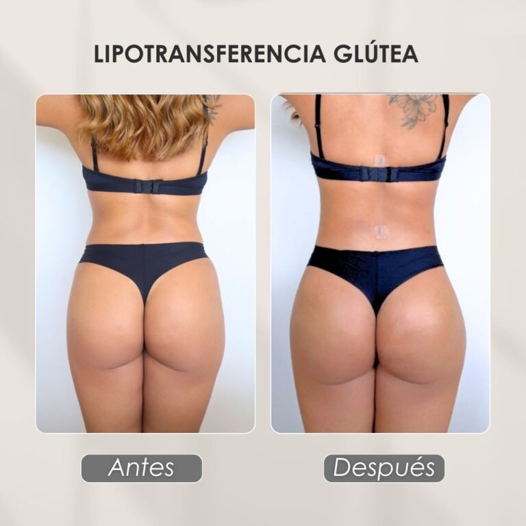 Antes y después de una lipotransferencia glútea - Dra. Daniela Correa - Cirujana Plástica en Medellín