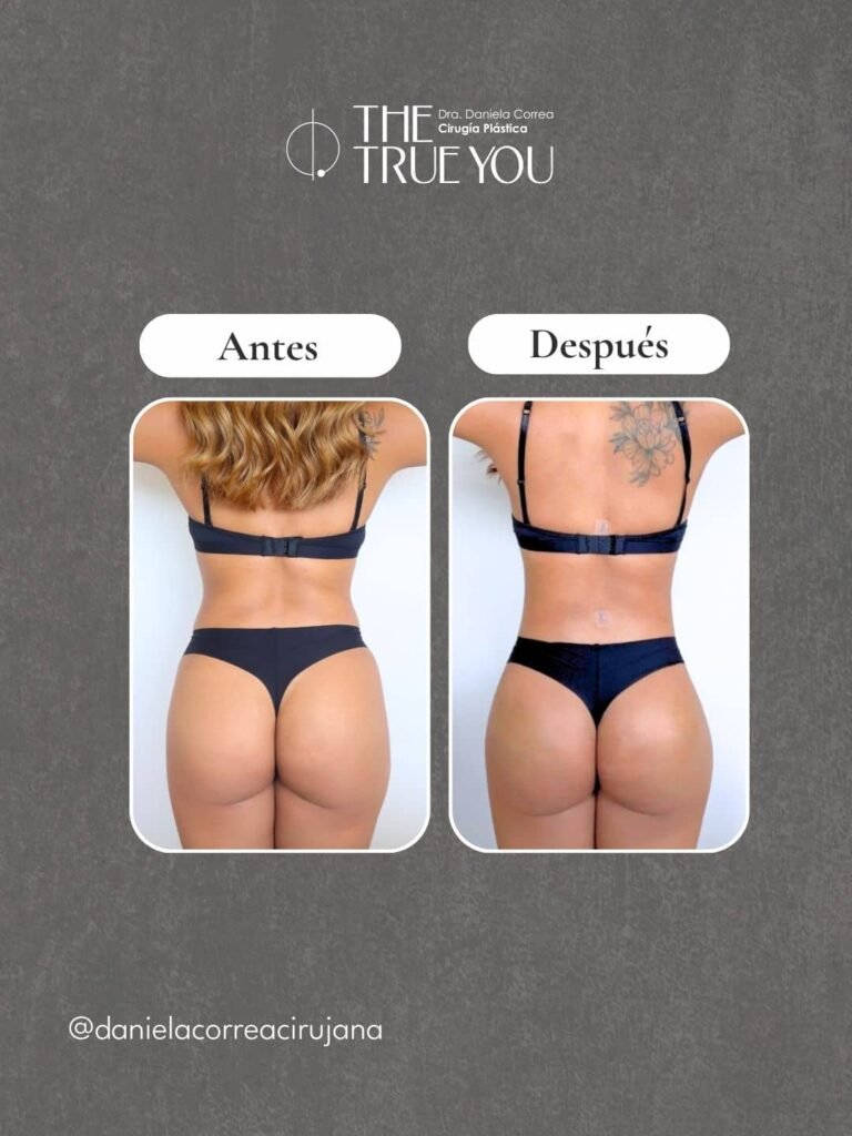 Lipotransferencia en Medellín antes y después - Dra. Daniela Correa cirujana plástica