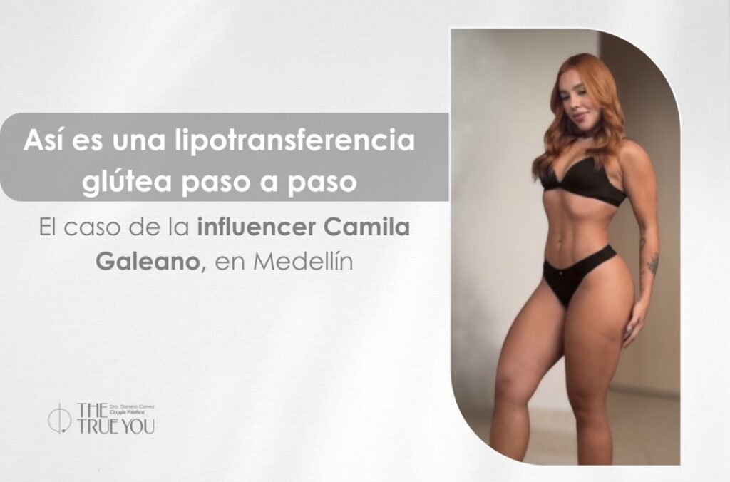 Lipotransferencia glútea paso a paso en Medellín - influencer Camila Galeano - Cirujana plástica Daniela Correa