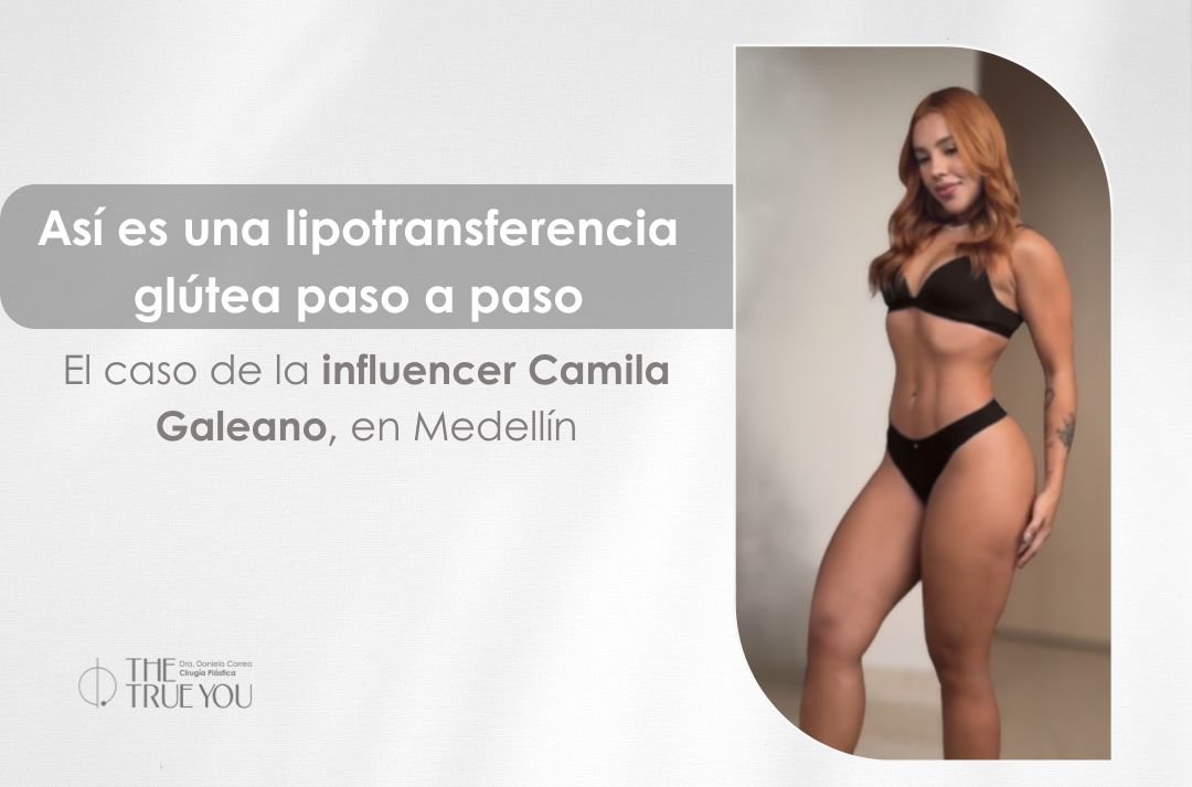 Lipotransferencia glútea paso a paso en Medellín - influencer Camila Galeano - Cirujana plástica Daniela Correa