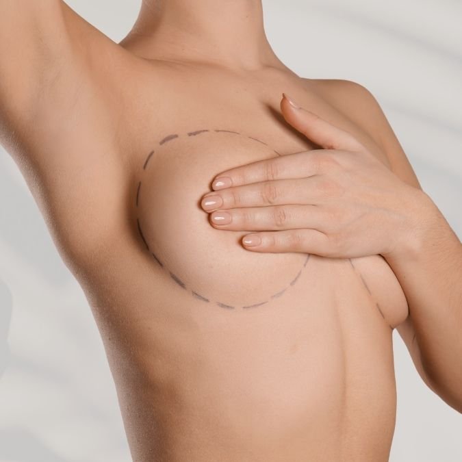Mamoplastia de aumento