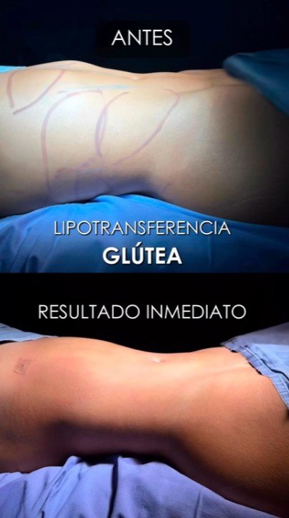 Resultado inmediato de lipotransferencia glútea en Medellín - Cirujana plástica Daniela Correa