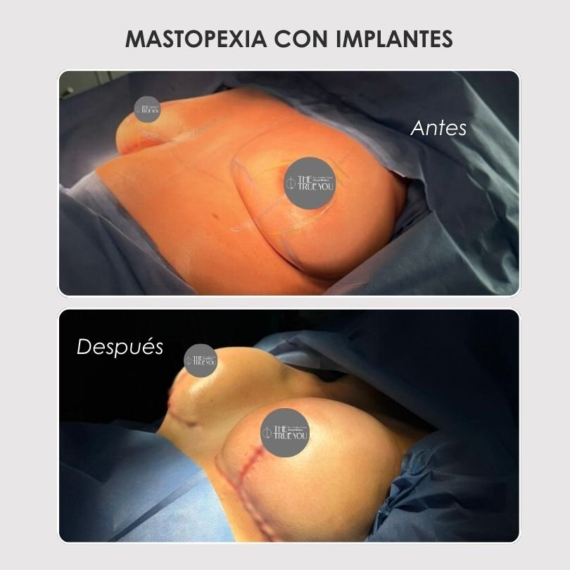 Antes-y-despues-de-una-Mastopexia-con-Implantes-Dra.-Daniela-Correa-Cirujana-Plastica-en-Medellin-y-Rionegro.jpg