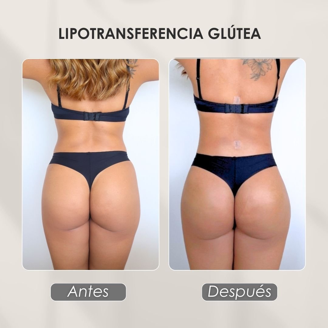 Antes-y-despues-de-una-lipotransferencia-glutea-Dra.-Daniela-Correa-Cirujana-Plastica-en-Medellin.jpg