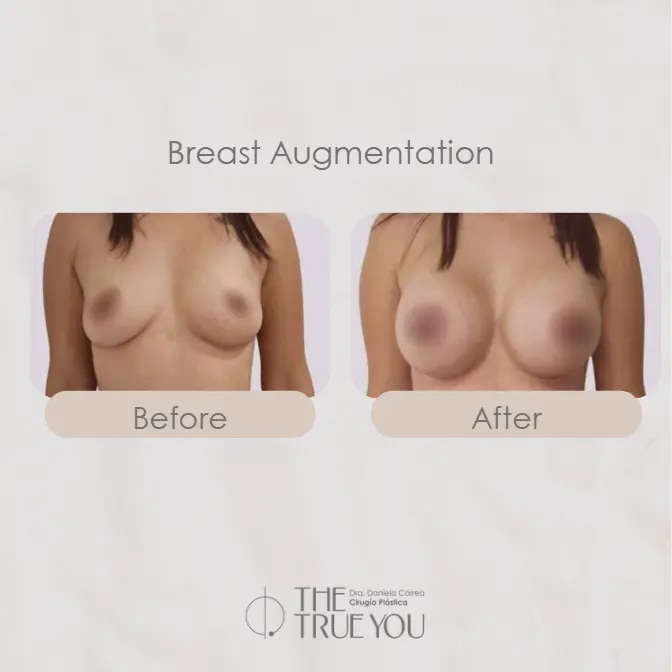 Breast Augmentation in Colombia-Dra. Daniela Correa