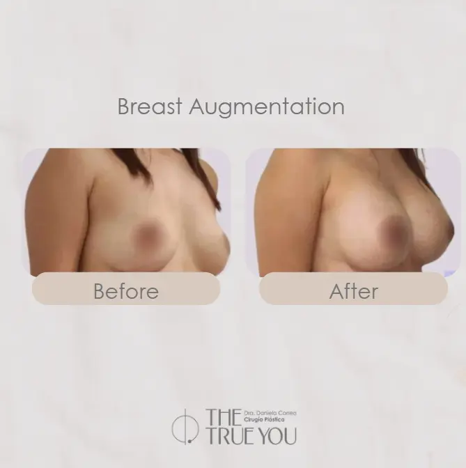 Breast Augmentation in Colombia-Dra. Daniela Correa