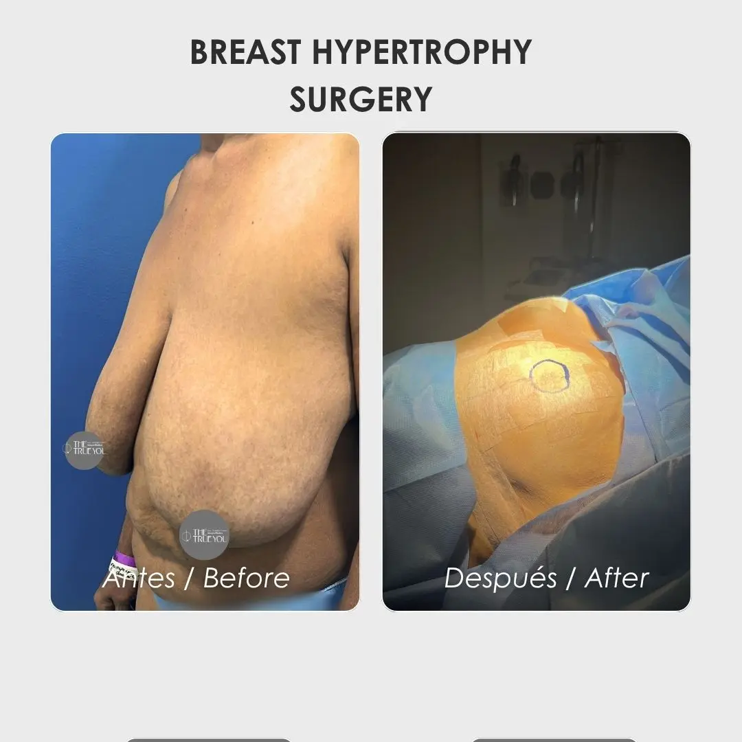Breast hypertrophy surgery - colombian plastic surgery before and after - Dr. Daniela Correa 1