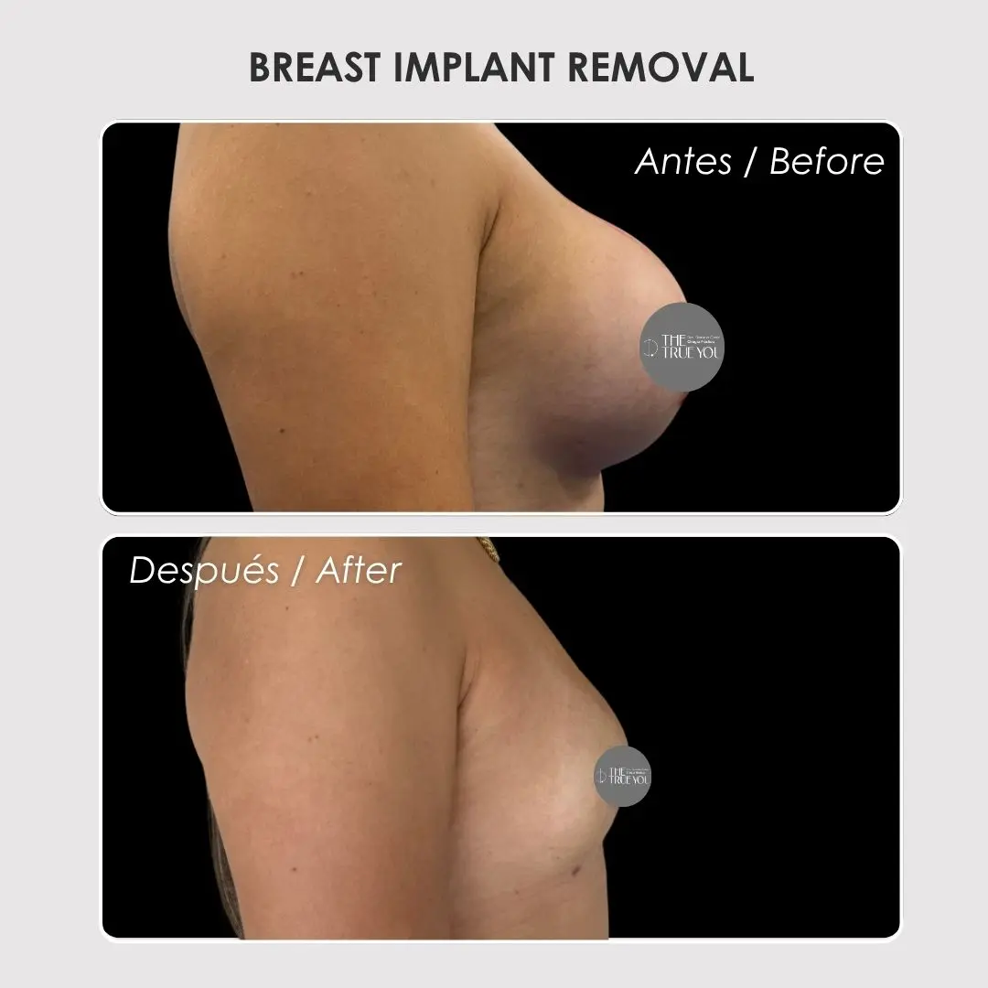 Breast implant removal - colombian plastic surgery before and after - Dr. Daniela Correa 1