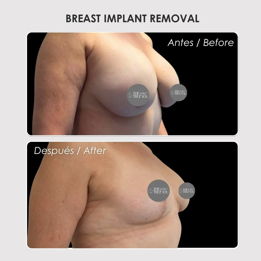 Breast implant removal - colombian plastic surgery before and after - Dr. Daniela Correa