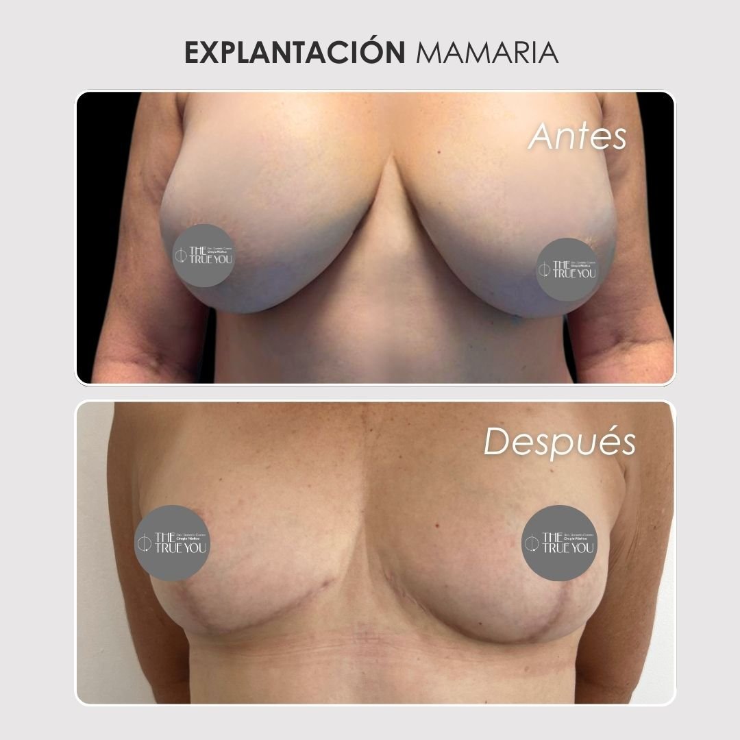 Explantacion-mamaria-Antes-y-despues-Daniela-Correa-Cirujana.jpg