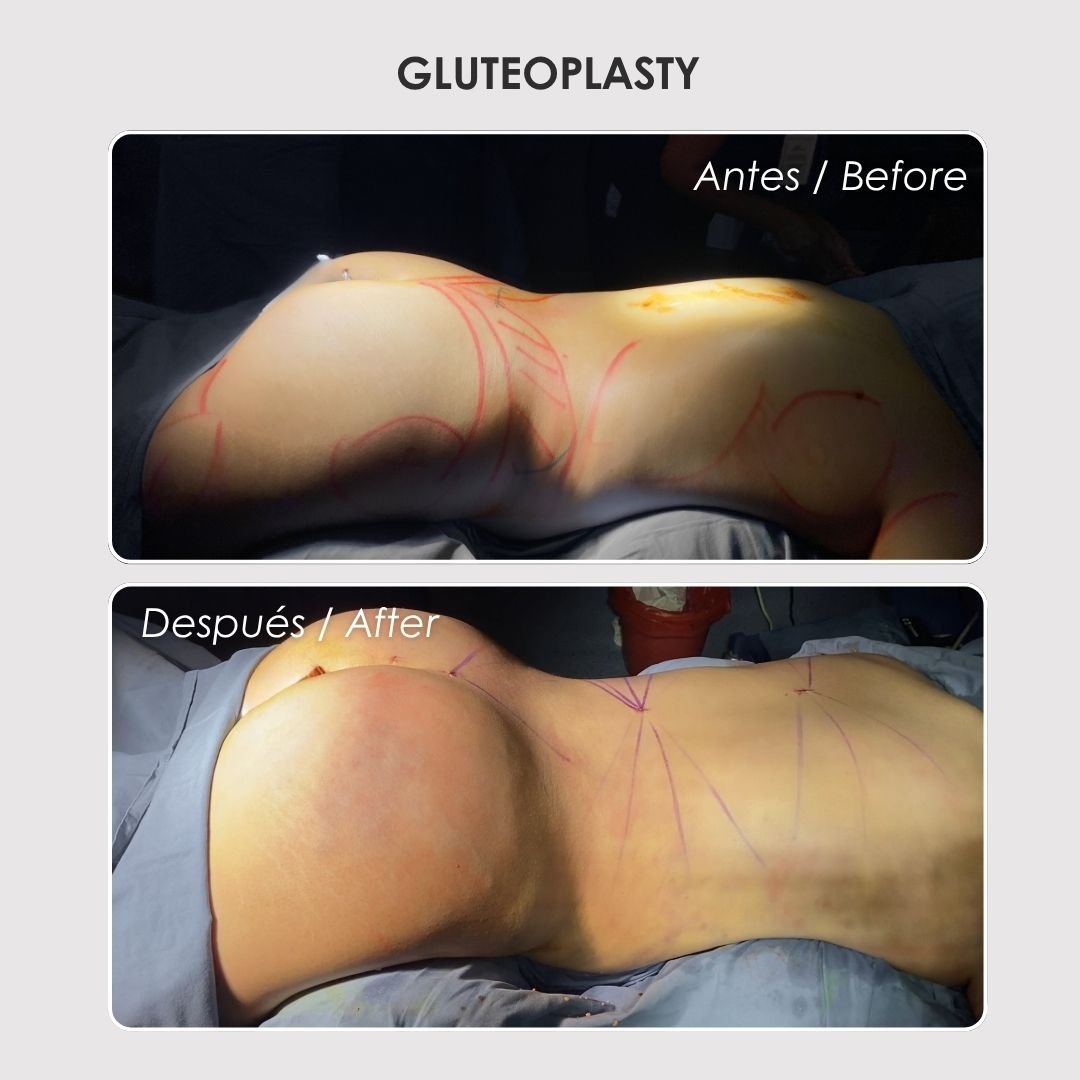 Gluteoplasty - colombian plastic surgery before and after - Dr. Daniela Correa 2
